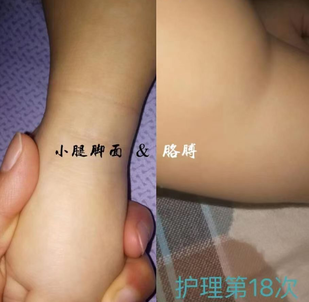 鱼鳞病前后对比